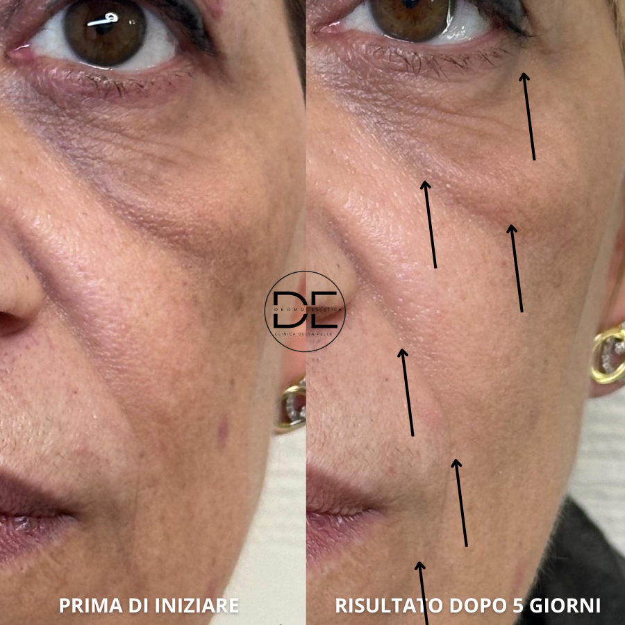 Blefaro Senza Bisturi a Monza: Prima & Dopo