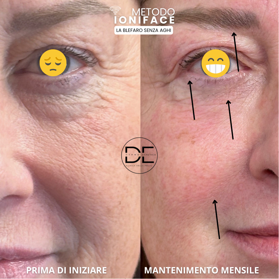 Blefaroplastica Non Chirurgica con Flusso Ionico: Il Trattamento Rivoluzionario di Dimensione Estetica - La Clinica della Pelle a Varedo