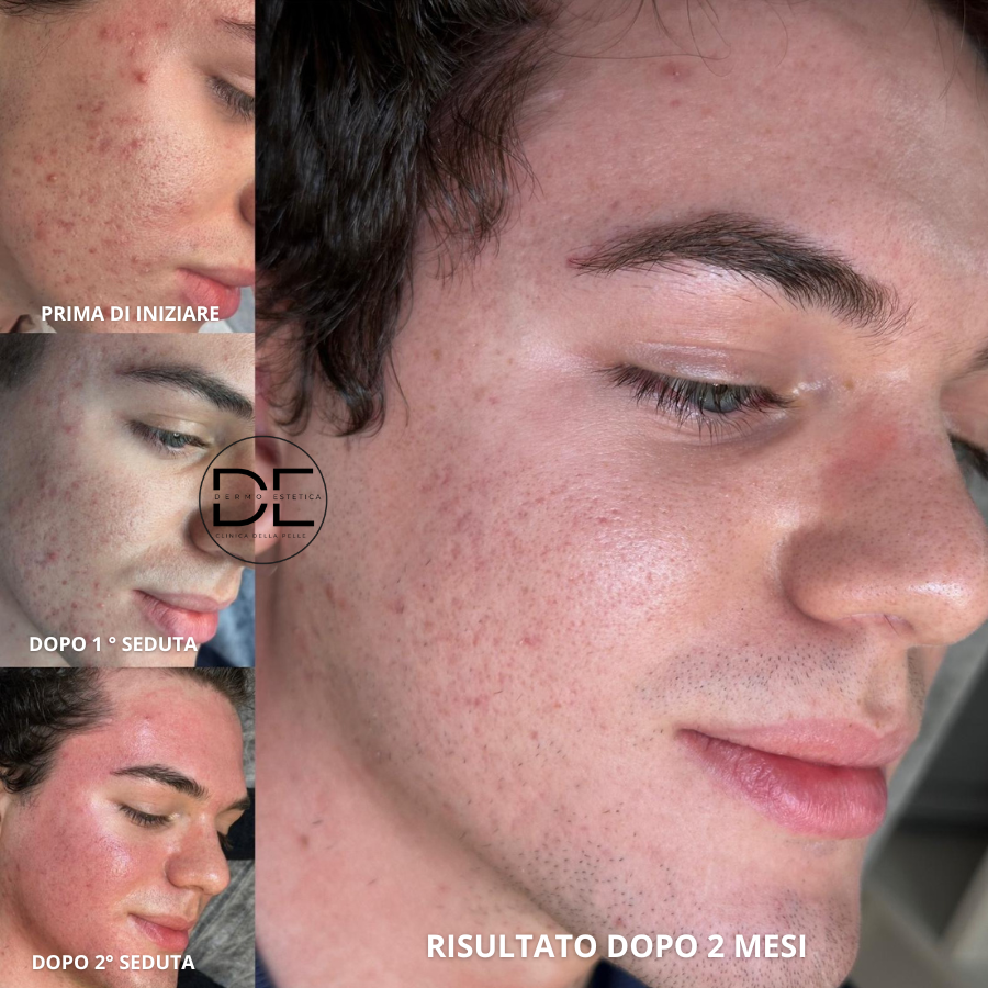 Trattamenti per Guarire dll'Acne: Guarda le Foto e Scopri il Metodo