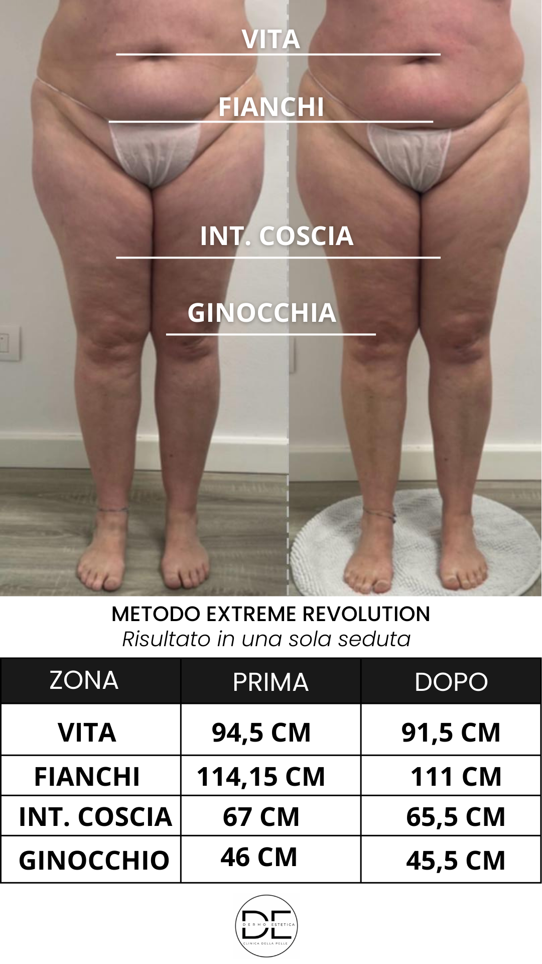 😣 Addome gonfio? Scopri cause, rimedi e il metodo efficace per tornare a una pancia piatta