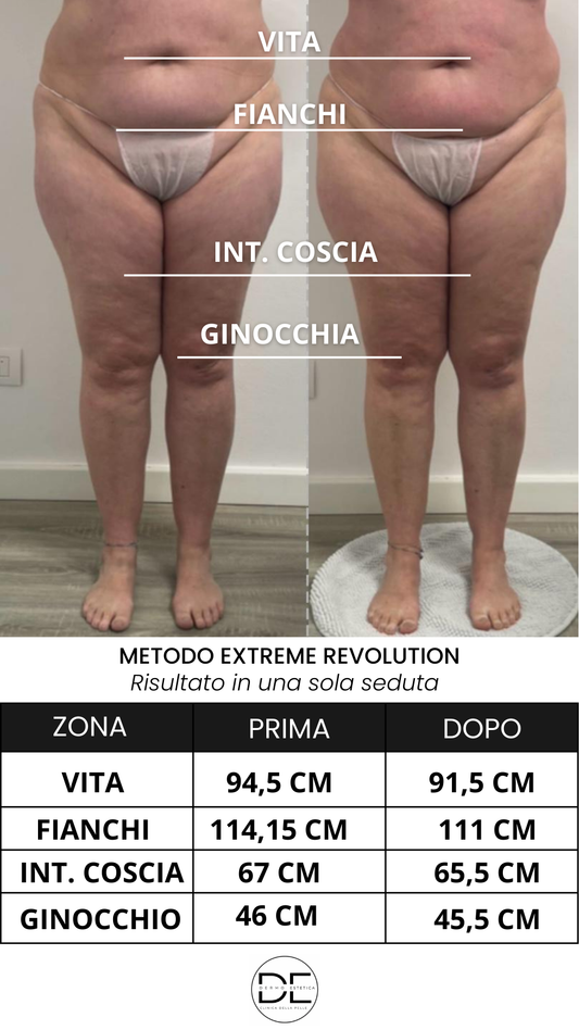 😣 Addome gonfio? Scopri cause, rimedi e il metodo efficace per tornare a una pancia piatta