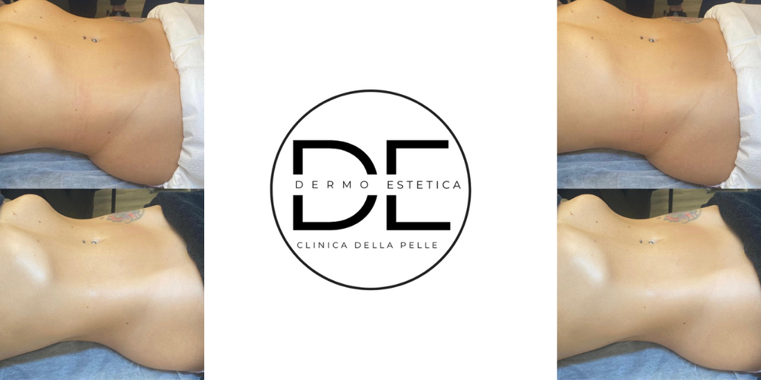 Carbossiterapia senza aghi a Monza e Brianza: la nuova frontiera del rimodellamento corpo, solo da Clinica della Pelle – Dimensione Estetica