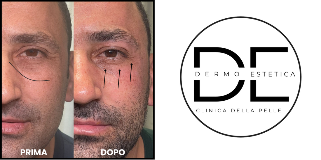Mesoterapia Occhi con Hypodermical a Monza Brianza: Il Blefaro Senza Aghi Firmato Metodo Ioniface