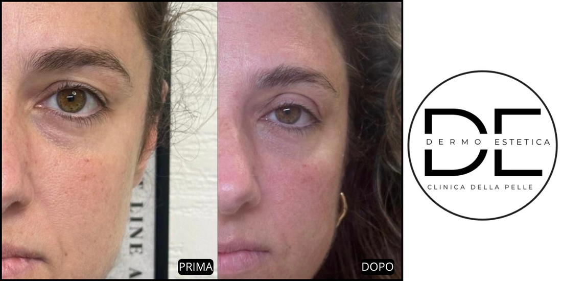 Carbossiterapia Viso con Hypodermical: Il Trattamento Antiage a Monza Brianza Firmato Metodo Ioniface