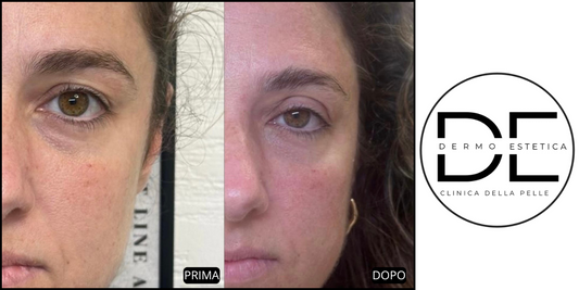 Carbossiterapia Viso con Hypodermical: Il Trattamento Antiage a Monza Brianza Firmato Metodo Ioniface