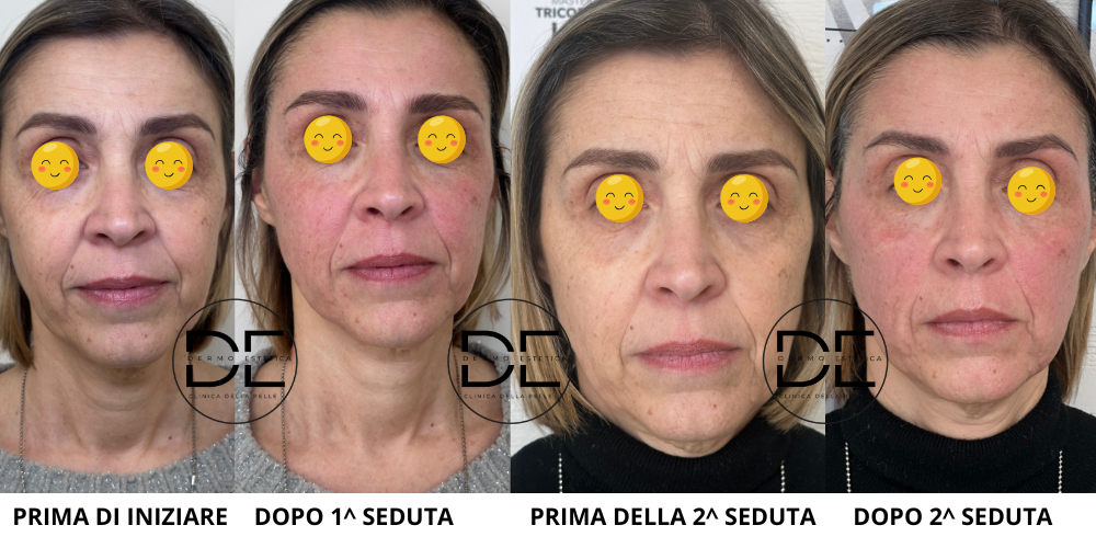 Metodo Ioniface: Il Lifting Non Chirurgico Avanzato a Monza e Brianza