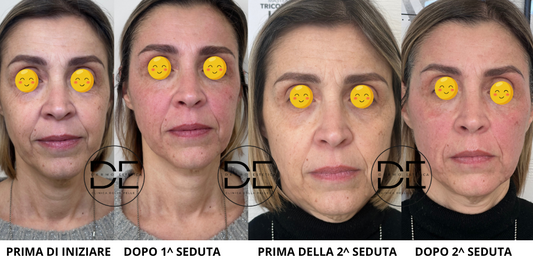 Metodo Ioniface: Il Lifting Non Chirurgico Avanzato a Monza e Brianza