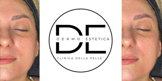 Eliminare le rughe naso-labiali a Monza Brianza con Ioni Face: il lifting naturale che rigenera la tua pelle