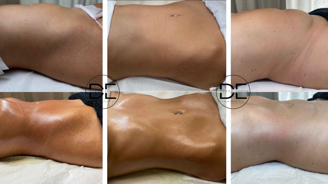 Addome sgonfio e più leggero in 3 sedute: il trattamento che funziona davvero a Monza e Brianza