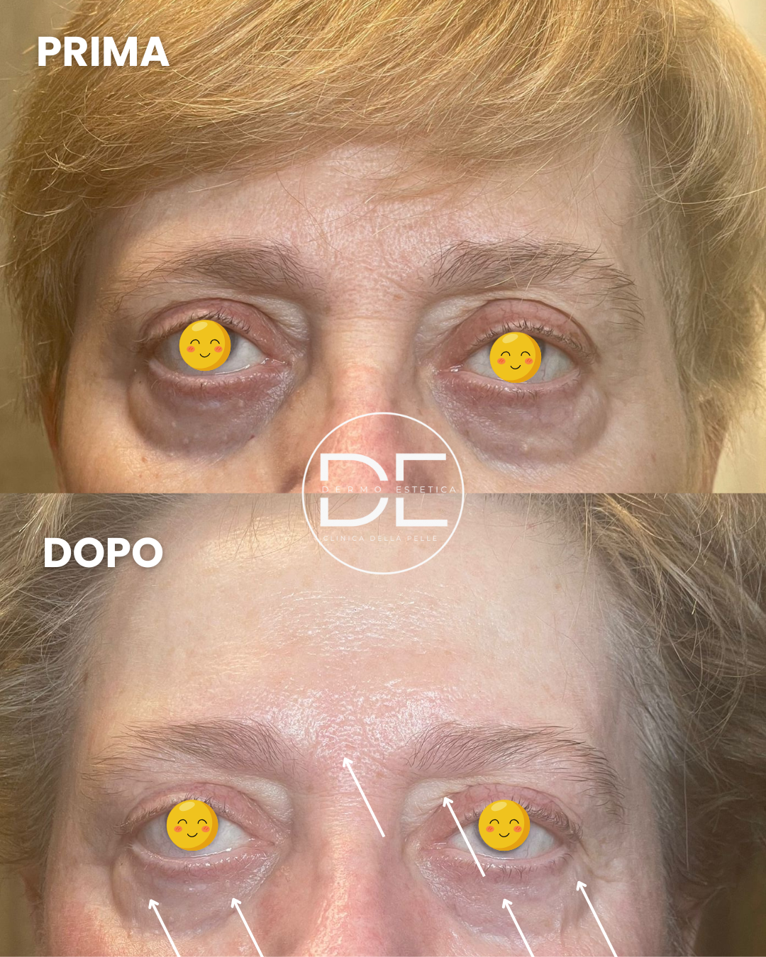 Borse e Occhiaie: Perché si Formano e Come Eliminarle con il Metodo Ioniface