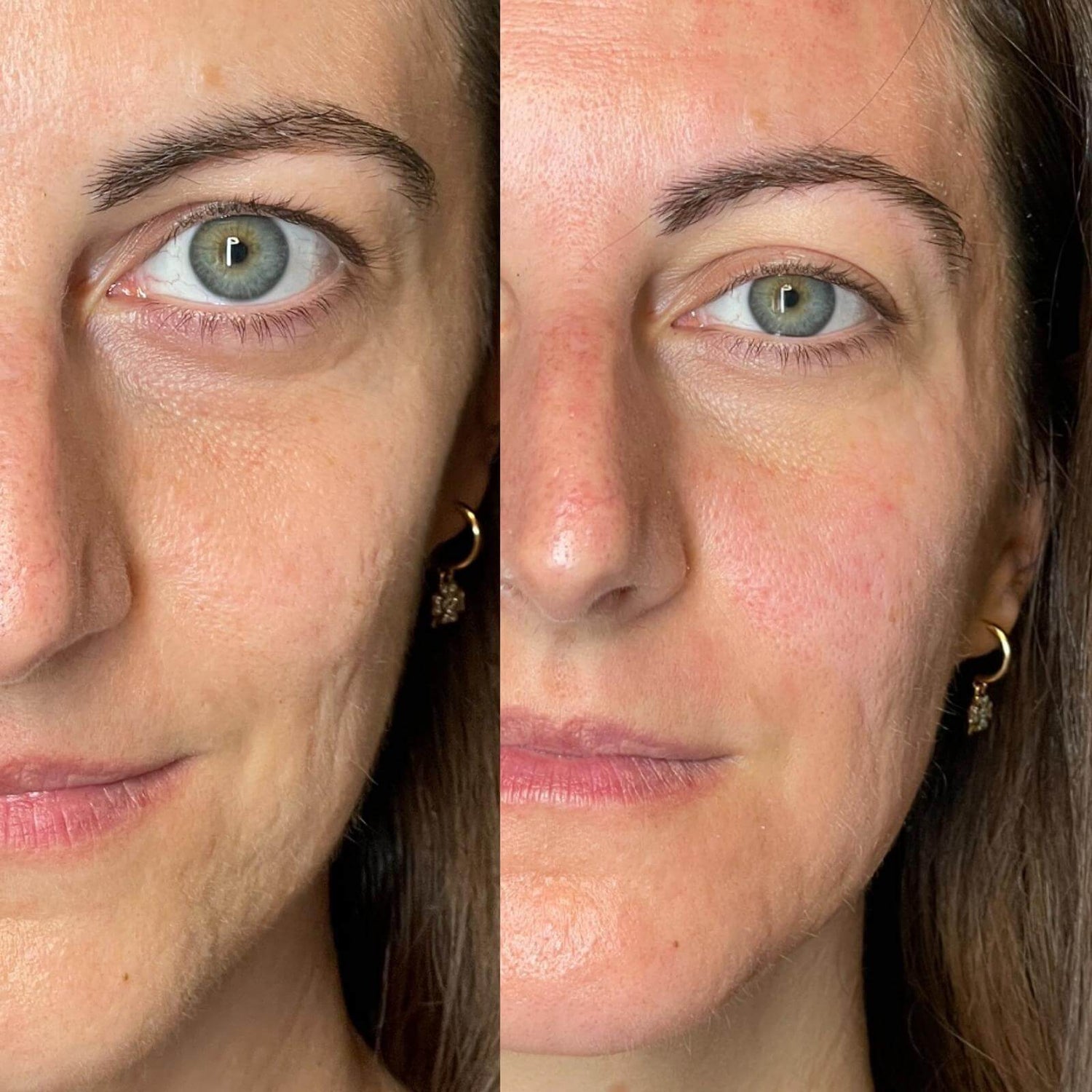 lifting e blefaro senza aghi monza